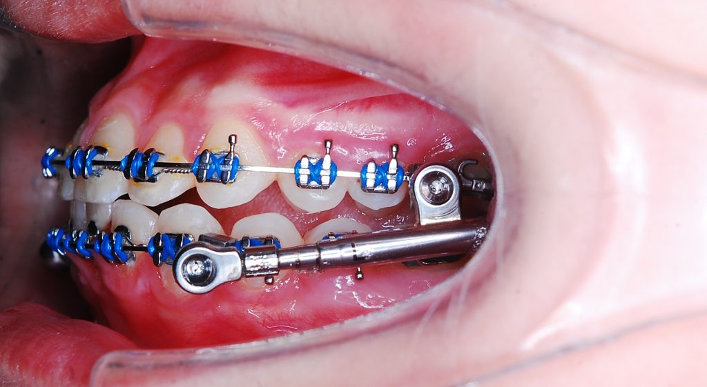 To read Compulsion attractive Aparat ortodontic functional - Orto Dental